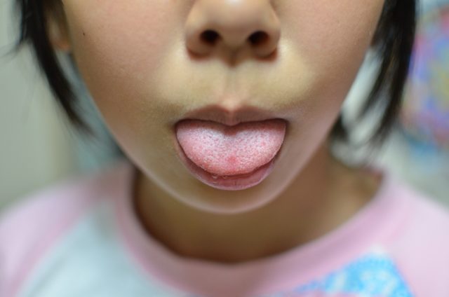 子供が口の周りをなめるのはチック 荒れて黒くなった時の薬や対処法